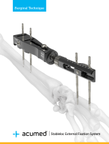 acumedStableloc External Fixation System